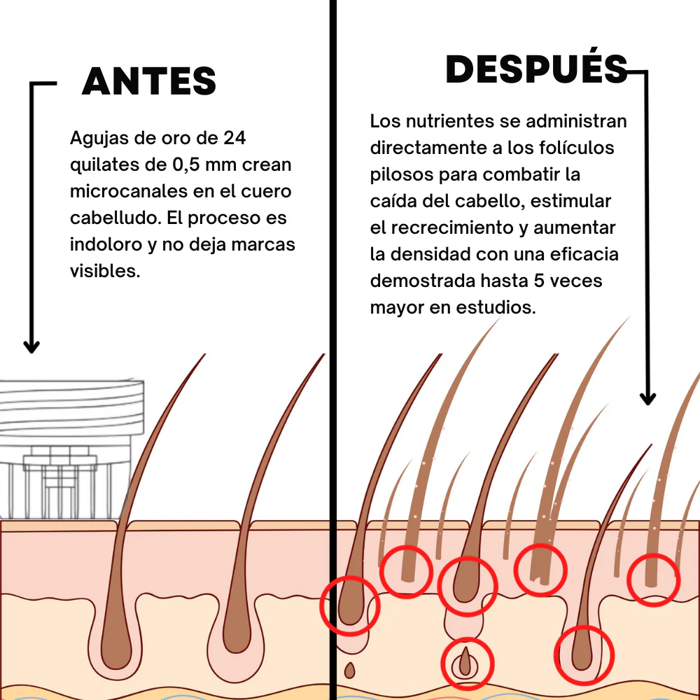 Beast Hair  – Recupera tu cabello con microinfusiones