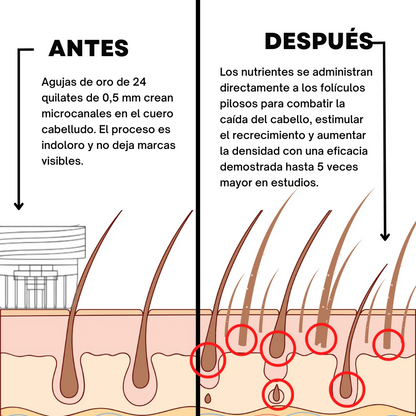 Beast Hair  – Recupera tu cabello con microinfusiones