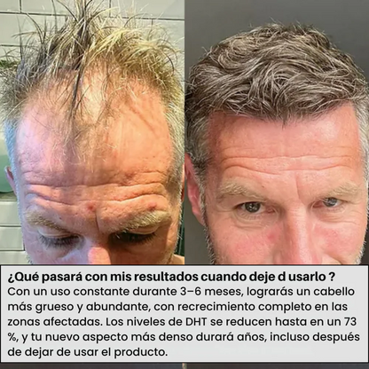 Beast Hair  – Recupera tu cabello con microinfusiones